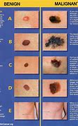 Image result for Lump Under Skin Melanoma