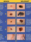 Image result for Melanoma Skin Lesions