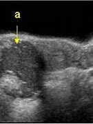 Image result for Dermoid Cyst Ultrasound