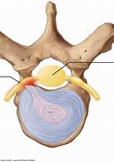 Image result for intervertegral