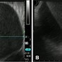 Image result for Anechoic Perimetrium On Ultrasound