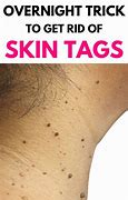 Image result for Long Warts