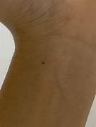 Image result for Dark Red Spot On Wrist