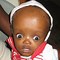 Image result for Baby Born with Hydrocephalus