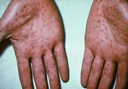 Image result for Syphilis Hands