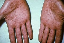 Image result for Tertiary Syphilis Symptoms