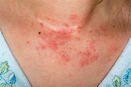 Image result for Eczema Skin Rash