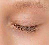 Image result for Face Warts