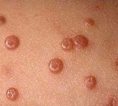 Image result for Skin Virus Molluscum