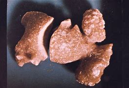 Image result for What Does a 4 mm Kidney Stone Look Like