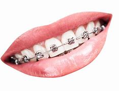 Image result for Braces with Missing Teeth