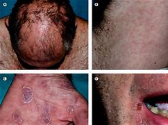 Image result for Syphilis Patient