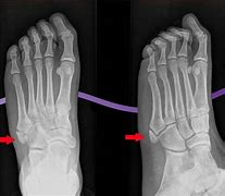 Image result for Measuered Foot Growth