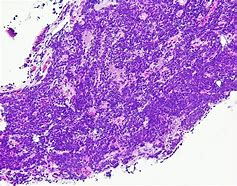 Image result for Small Cell Carcinoma Diagram