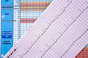 Image result for Carotid Pulse