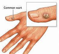 Image result for Common Wart Anatomy