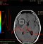 Image result for astrocytoma