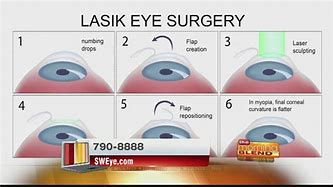 Image result for Refractive Surgery Eyelid