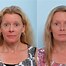 Image result for Before and After Botox Face