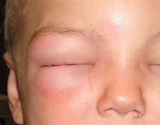 Image result for Allergic Reaction Face Swelling