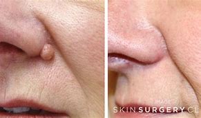 Image result for Mole Removal On Nose