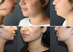 Image result for Weak Jawline Female