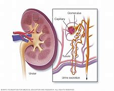 Image result for IgA Nephropathy Berger's Disease