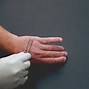 Image result for Periungual Wart On Thumb
