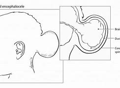 Image result for Cranial Encephalocele