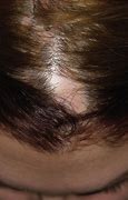 Image result for Cicatricial Alopecia