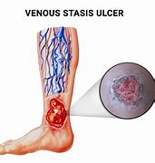 Image result for Venous Stasis Leg Ulcer