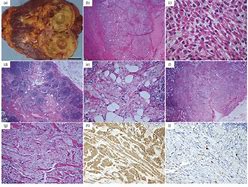 Image result for How Big Is 8 Cm Tumor