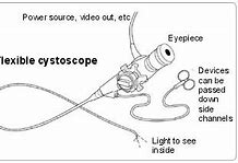 Image result for Pictures Inside Bladder Cystoscopy