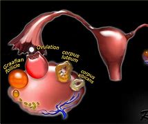 Image result for Ovarian Cyst with Debris
