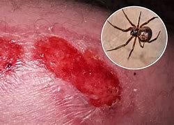 Image result for Pop Spider Bite Blister