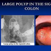 Image result for 5 Cm Polyp in Colon