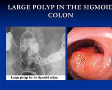 Image result for 20 Cm Polyp in Colon