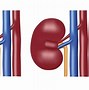 Image result for Simple Renal Cyst