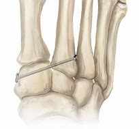 Image result for Lisfranc Fracture Plate