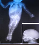 Image result for X-ray of Sirenomelia
