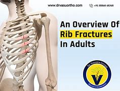 Image result for 8th Rib Fracture