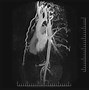 Image result for Angioplasty Carotid Artery Stent