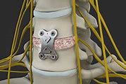 Image result for Anterior Cervical Discectomy with Fusion