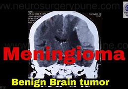 Image result for Benign Meningioma