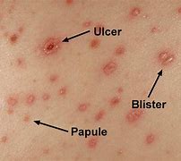 Image result for Chickenpox
