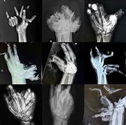 Image result for Exploded Hand