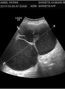 Image result for Ovarian Cyst with Septation