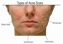 Image result for Acne Scar Model