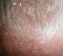 Image result for Dermatitis