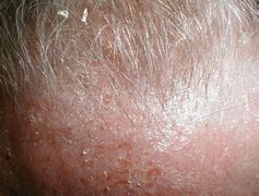 Image result for Eczema Skin Rash Pictures